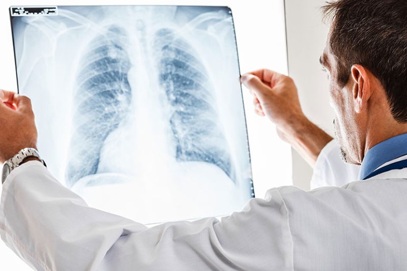 nodulos-pulmonares1